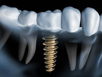 Diagram showing how dental implants in Annadale work
