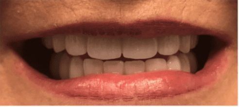 Healthy smile after dental restoration