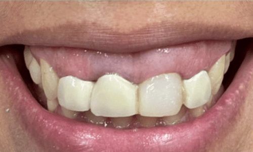 Smile with excessive gum tissue before cosmetic dentistry treatment