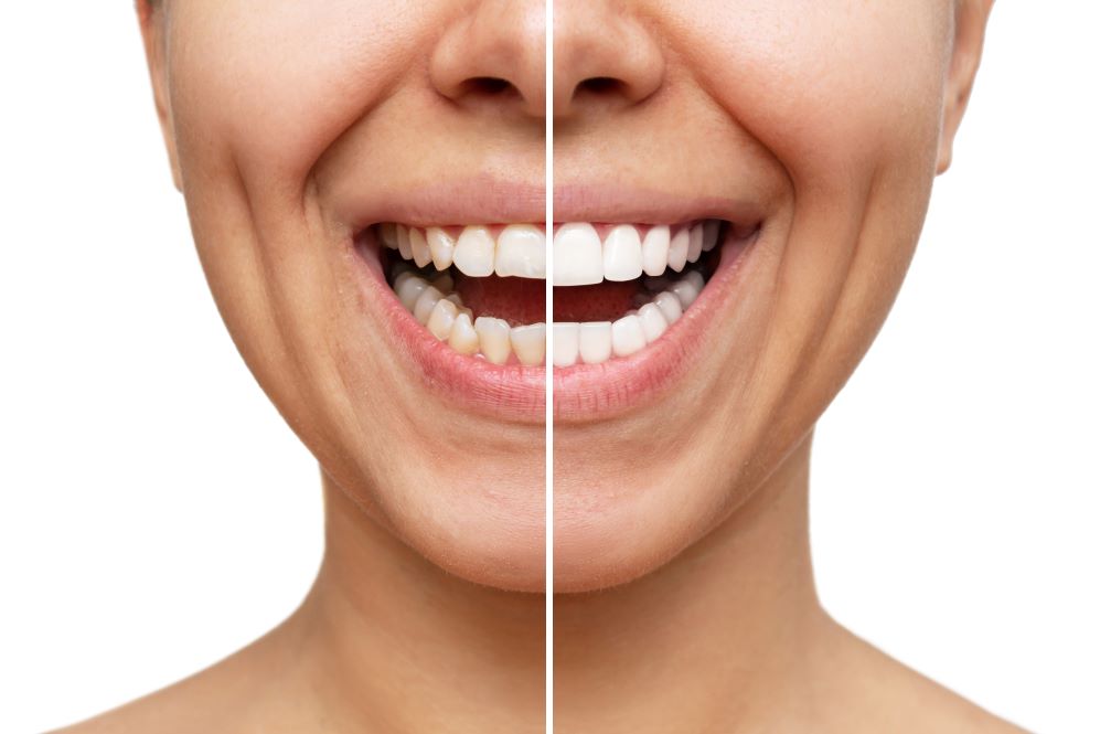 A woman before and after getting veneers.