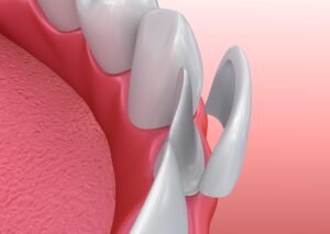 Model of a veneer next to a prepared tooth